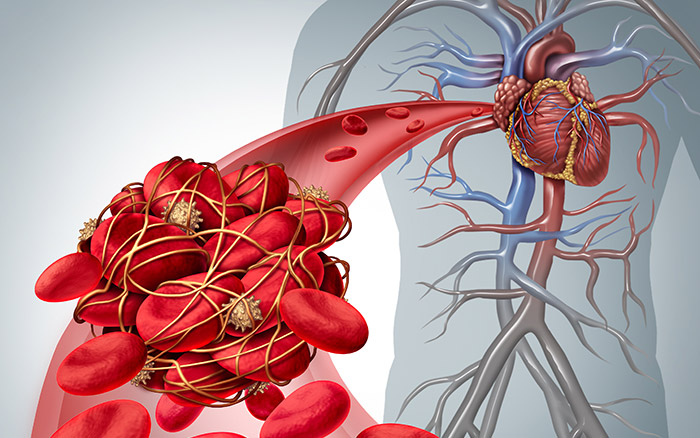 Prothrombin Mutation