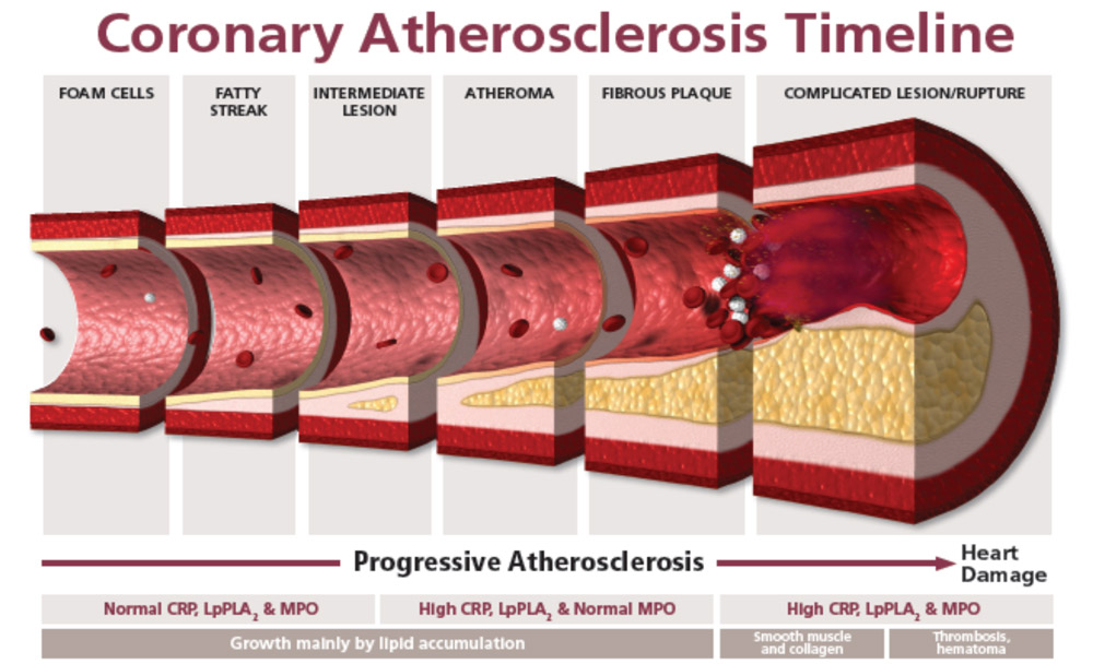 atherosclerosis