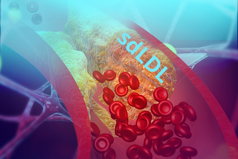 sdLDL test